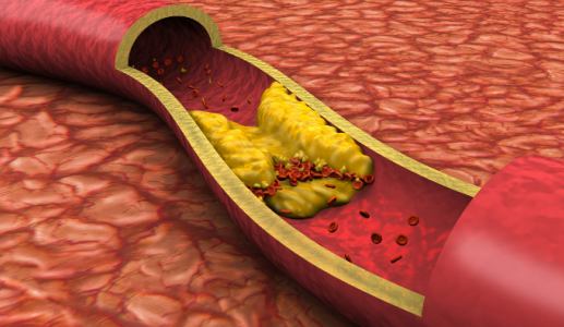 Cholesterol cao và xơ vữa động mạch: Mối liên hệ nhiều người còn chủ quan