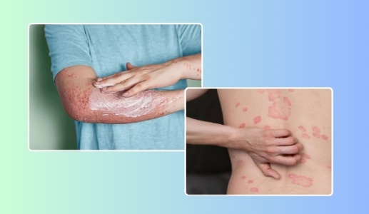 Mẹo chăm sóc da cho người bệnh vảy nến thể mảng