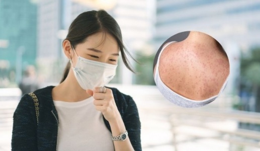 Người lớn cũng bị sởi: Bà bầu cần lưu ý gì?