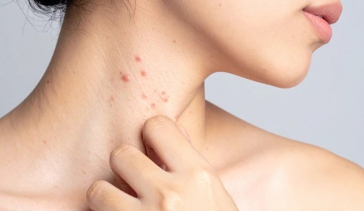 Hướng đi mới giúp kiểm soát bệnh lupus ban đỏ từ thảo dược tự nhiên