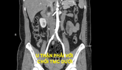 Tình cờ phát hiện u thận kèm huyết khối tĩnh mạch chủ