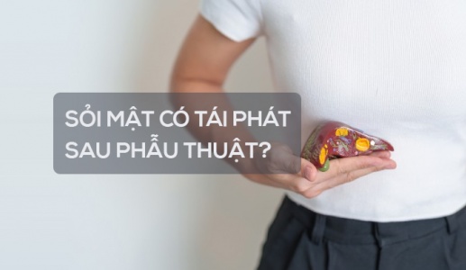 Sỏi mật có tái phát sau phẫu thuật không?