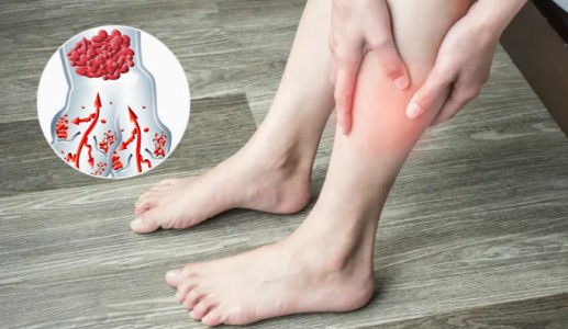 4 dấu hiệu cảnh báo cục máu đông phụ nữ không nên chủ quan