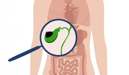 Đa polyp túi mật 9x8mm nên xử trí thế nào?