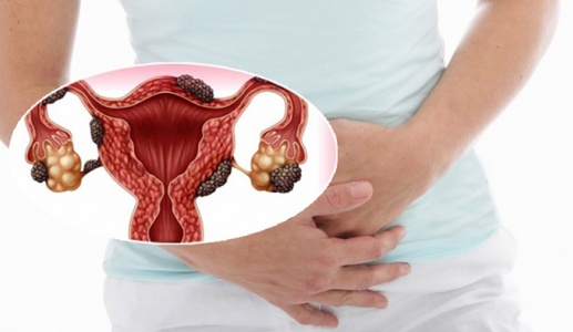 Đau bụng kinh do lạc nội mạc tử cung - cách nào để cải thiện?