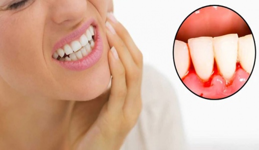 Bị viêm quanh răng có nguy hiểm không?