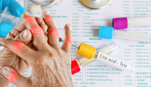 Chế độ ăn cho người có chỉ số acid uric tăng cao
