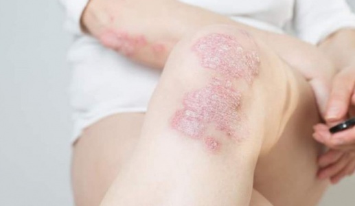 Chủ động kiểm soát vảy nến từ sớm để không lo bệnh bùng phát khi trời lạnh
