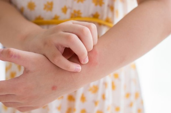 Giải pháp thảo dược cho trẻ bị nổi mề đay