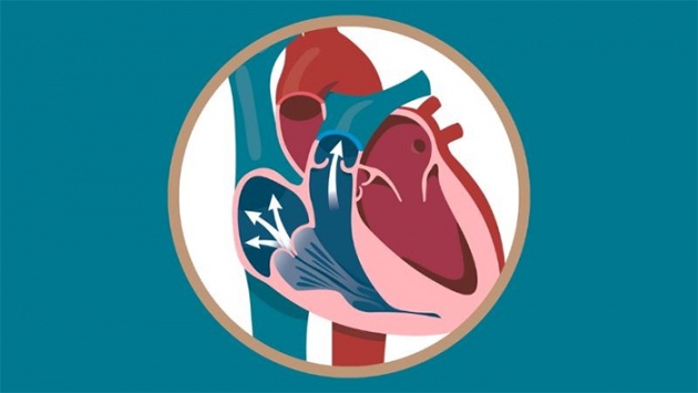Hở van động mạch phổi có gây biến chứng gì nguy hiểm không? 