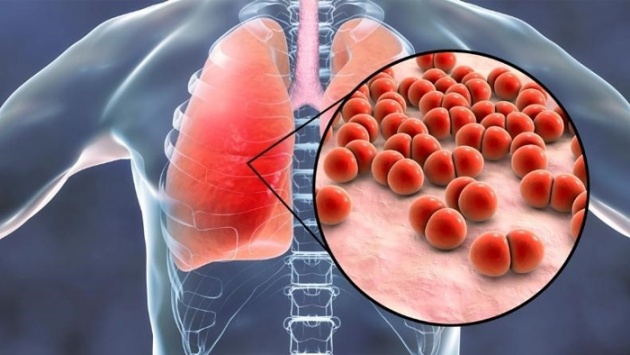 Các bệnh do phế cầu khuẩn ngày càng tăng, diễn biến khó lường