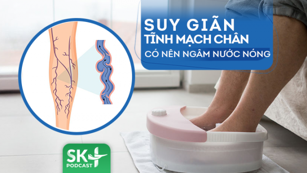 Podcast: Suy giãn tĩnh mạch chân có nên ngâm nước nóng?