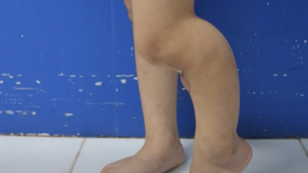 Có nên chữa gãy xương, viêm xương cho trẻ bằng cách đắp lá?	
