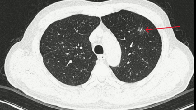 Đi khám sỏi thận, phát hiện ung thư phổi giai đoạn sớm nhờ AI