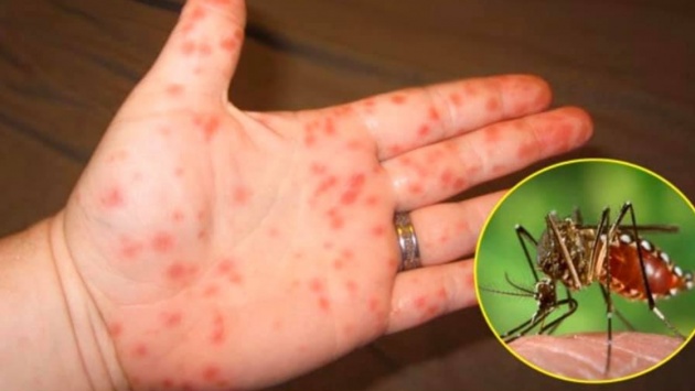 Sốt xuất huyết, tay chân miệng nặng tăng cao, Bộ Y tế cảnh báo khẩn