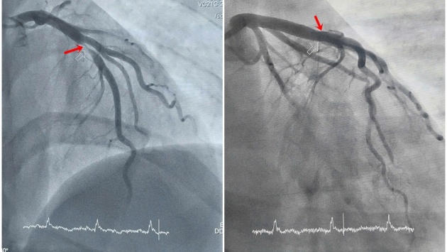 Thanh niên 29 tuổi phát hiện nhồi máu cơ tim cấp khi đi nội soi dạ dày