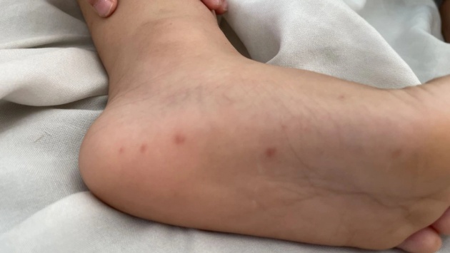 Ca bệnh tay chân miệng tăng gấp 5 lần, Bộ Y tế yêu cầu siết chặt kiểm soát