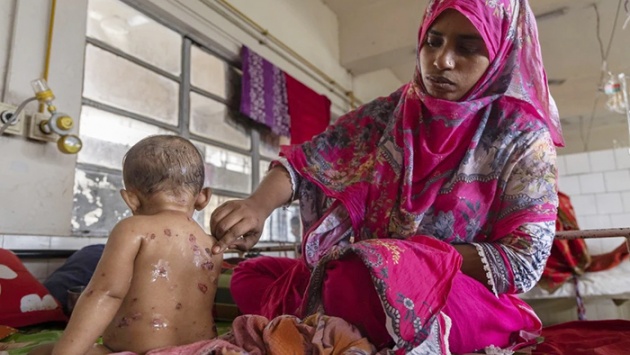 Bangladesh: Gần 100 trẻ em tử vong nghi do dịch sởi bùng phát