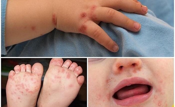 Sốt xuất huyết và tay chân miệng cùng gia tăng mạnh