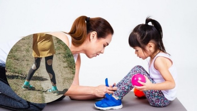 Khớp gối vẹo ngoài: Dáng đi bất thường ở trẻ cha mẹ nên theo dõi