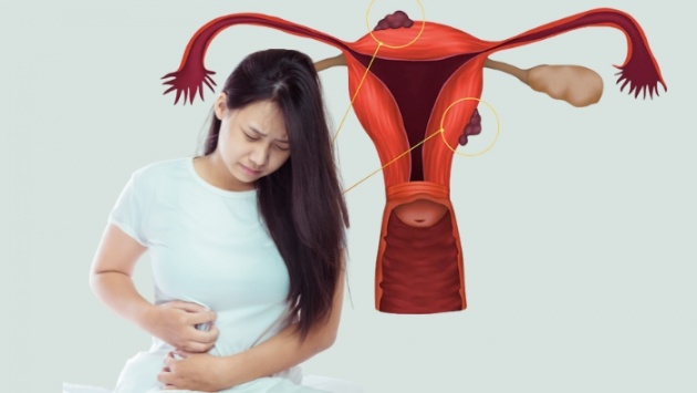 Sang chấn tâm lý có thể thúc đẩy bệnh lạc nội mạc tử cung