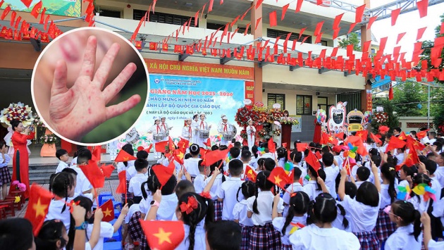 Bộ Y tế cảnh báo gia tăng bệnh tay chân miệng trong mùa tựu trường