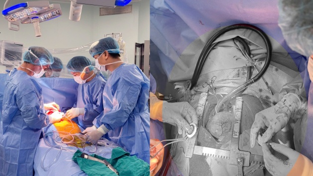 Việt Nam lần đầu cấy ghép thành công thiết bị hỗ trợ tim thế hệ mới CorHeart 6 
