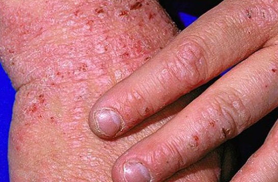 Káº¿t quáº£ hÃ¬nh áº£nh cho da dÃ y lÃªn do eczema