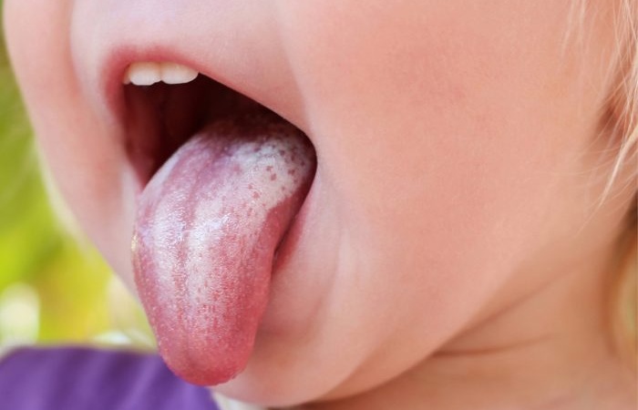 Biện pháp khắc phục nấm miệng (tưa lưỡi) ở trẻ nhỏ