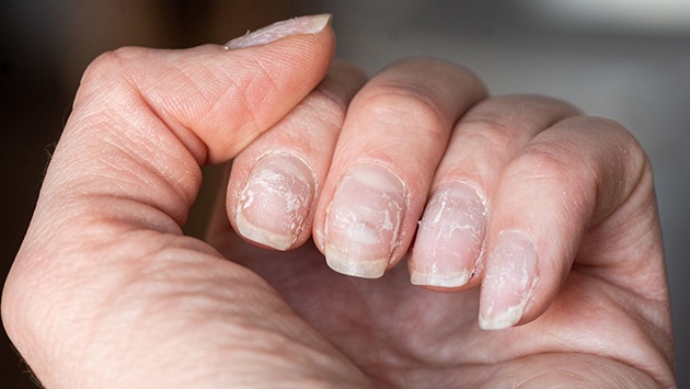 Nguyên nhân khiến móng tay dễ gãy, cách chăm sóc móng tay trong mùa Hè